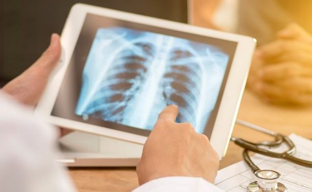 La tuberculosis es la principal causa de muerte de quienes viven con VIH en América Latina