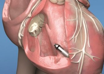 El marcapasos más pequeño del mundo ya está cambiando vidas en Colombia