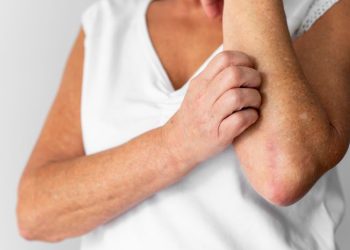 Psoriasis: tratamiento oportuno es clave para mejorar la calidad de vida de los pacientes