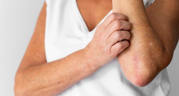 Psoriasis: tratamiento oportuno es clave para mejorar la calidad de vida de los pacientes