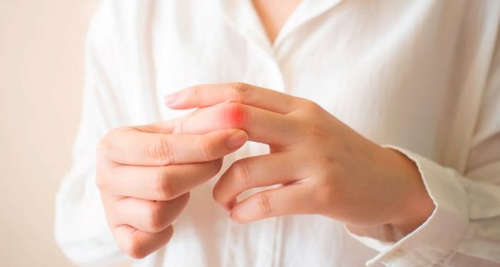 Lupus: “entendiendo la enfermedad y aprendiendo a vivir con ella”