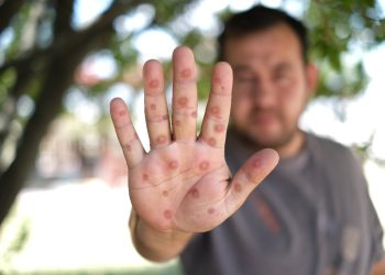 En Colombia, el Instituto Nacional de Salud ha confirmado 119 casos hasta el 18 de septiembre, de los cuales 3 permanecen activos de la cepa de tipo Clado II, aun no hay casos registrados del Clado IB en Colombia. Es importante resaltar que no se han presentado muertes asociadas con la enfermedad.