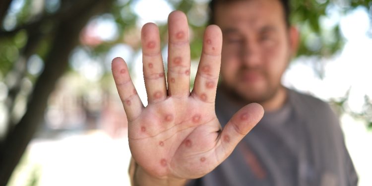 En Colombia, el Instituto Nacional de Salud ha confirmado 119 casos hasta el 18 de septiembre, de los cuales 3 permanecen activos de la cepa de tipo Clado II, aun no hay casos registrados del Clado IB en Colombia. Es importante resaltar que no se han presentado muertes asociadas con la enfermedad.